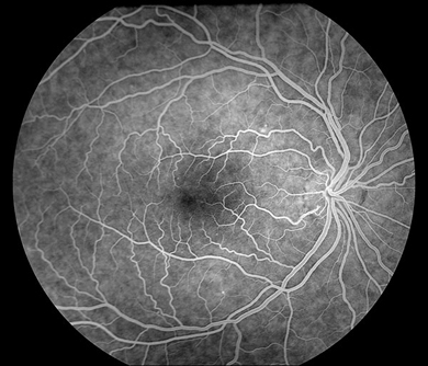 Fluorescein Angiography - LA Retina Center