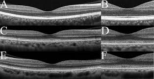 Optical Coherence Tomography - LA Retina Center