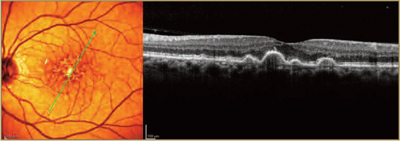 AMD - LA Retina Center