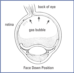 Macular Hole - LA Retina Center