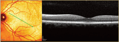 AMD - LA Retina Center