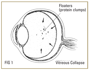 Retinal Detach Floaters