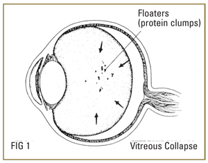 retinal-detach-floaters