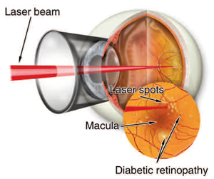 Diabetic Retinopathy - LA Retina Center