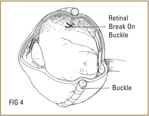 scleral-buckle