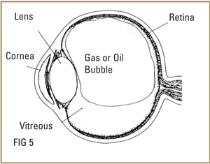 vitrectomy-surgery