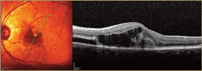 AMD - LA Retina Center